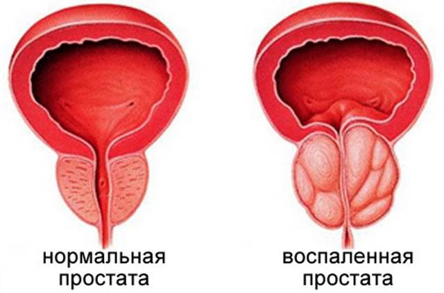 Жжение и зуд при простатите у мужчин: почему и как убрать?