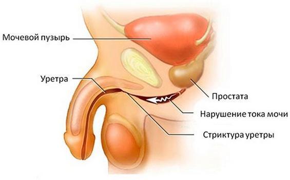 Лейкоцитоспермия у мужчин: причины, симптомы, лечение