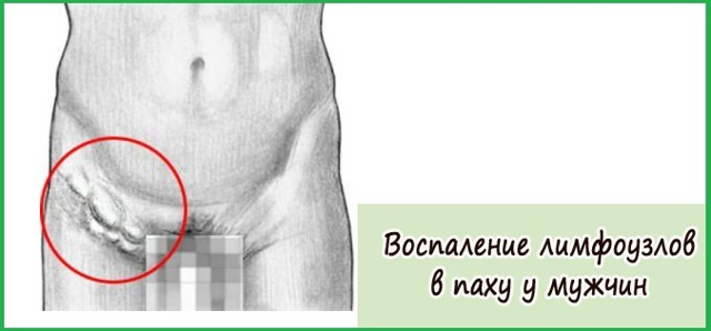 Боль в паху у мужчин справа и слева: причины и лечение