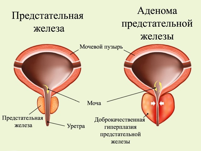 Жжение и зуд при простатите у мужчин: почему и как убрать?