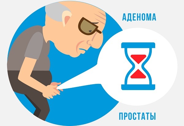 Аденома простаты у мужчин: симптомы и лечение, отзывы
