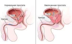 Чистотел от простатита, аденомы и рака простаты: лечение, отзывы мужчин