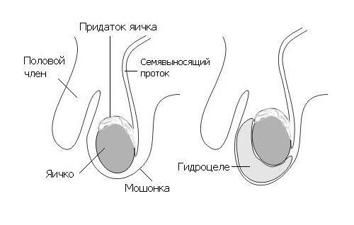 Опухли яички и болят у мужчины: причины, почему отекает мошонка, как лечить