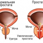 Прерванный половой акт (ППА): вред и последствия, мнение врачей