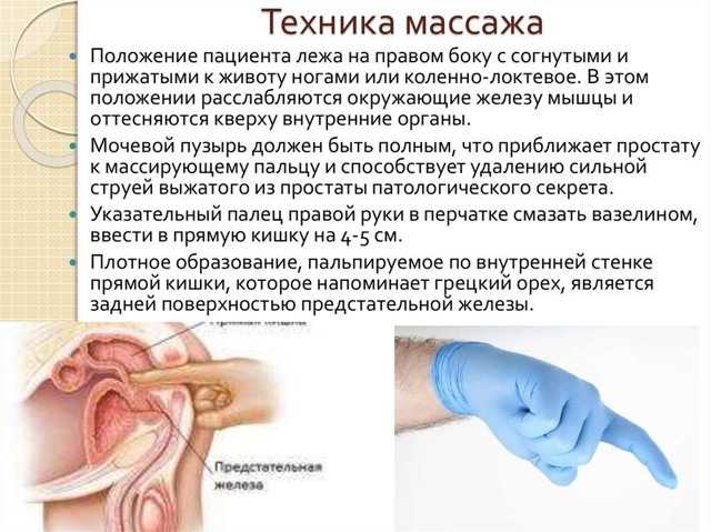 Массаж простаты: как делать самостоятельно и жене мужу, видеоурок