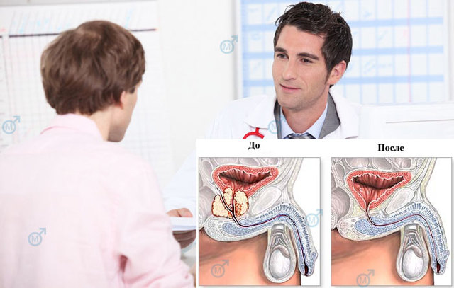 Восстановление потенции после удаления аденомы простаты