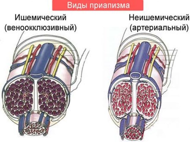 Приапизм у мужчин: лечение, симптомы, причины