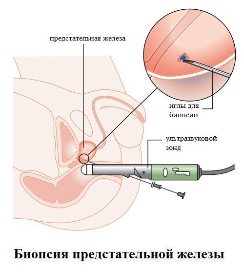Кровь в сперме у мужчин: причины и лечение, что это означает?