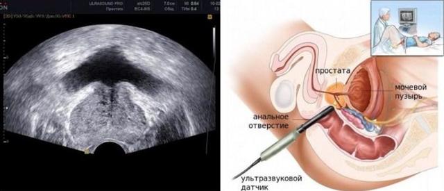 Потеря эрекции во время полового акта: причины, что делать мужчине?