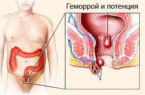 Влияет ли геморрой на потенцию у мужчин и как?