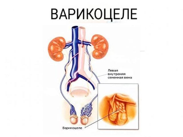 Влияет ли варикоцеле на потенцию мужчины и как?