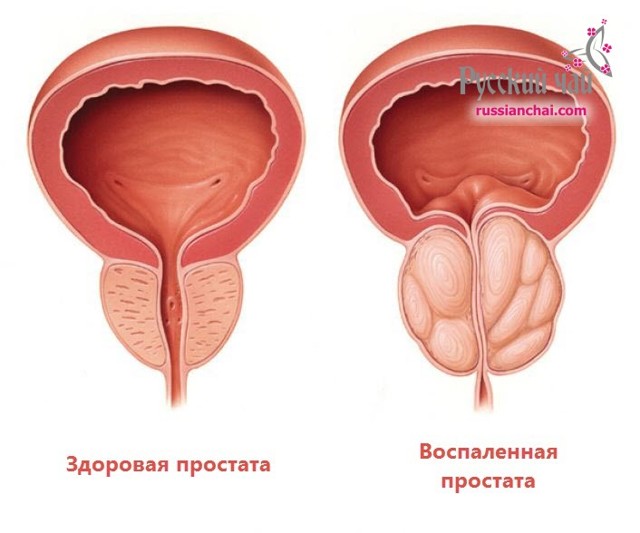 Иван-чай при простатите и аденоме простаты: как заваривать и пить, лечение, отзывы мужчин