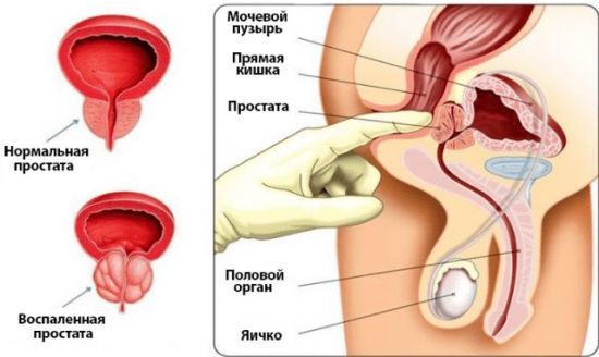 Эскузан при простатите: как применять, реальные отзывы мужчин