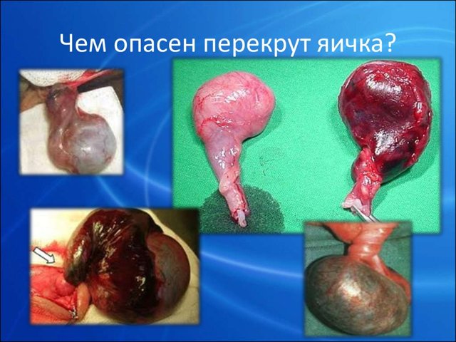 9 болезней яичек у мужчин и детей: описание, симптомы и лечение