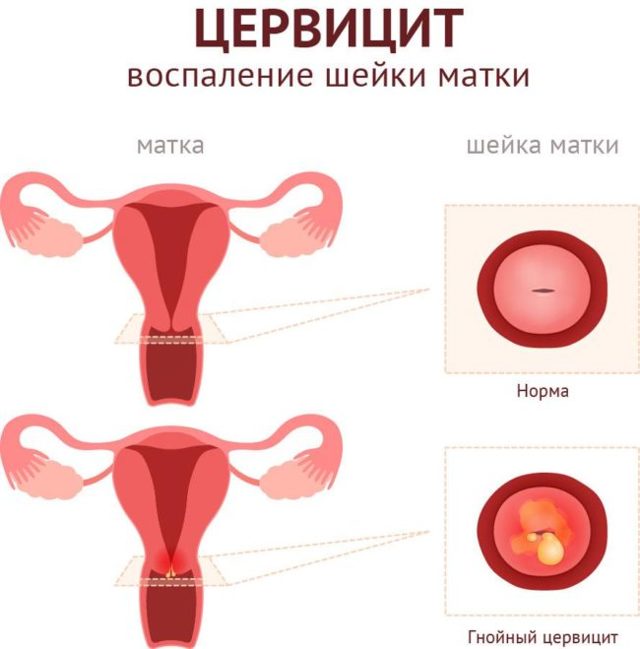 Простатит и зачатие (беременность): влияет ли болезнь на возможность иметь детей?