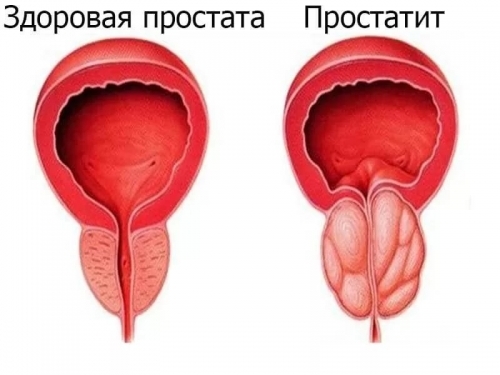 Запущенный простатит у мужчин: причины, симптомы и признаки, лечение