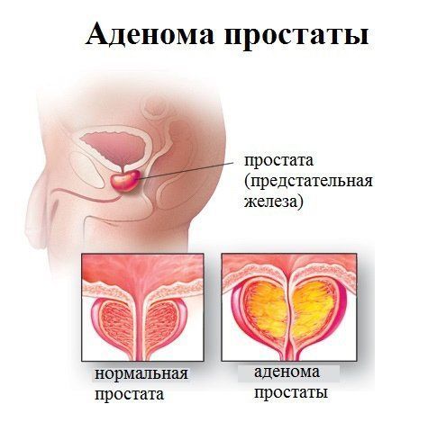 Лечебная физкультура (ЛФК) при простатите и аденоме простаты у мужчин