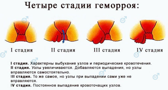 Влияет ли геморрой на потенцию у мужчин и как?