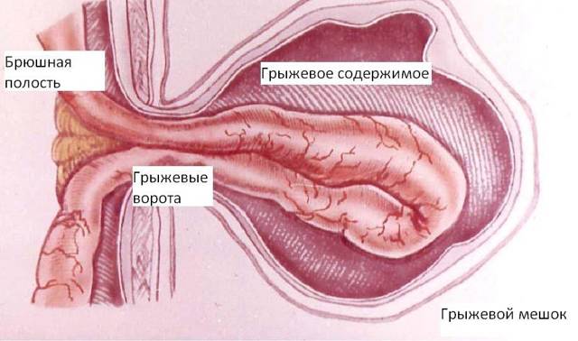 Влияние паховой грыжи на потенцию и эрекцию у мужчин