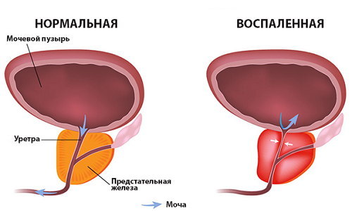 Ципрофлоксацин при простатите: схема лечения, отзывы мужчин