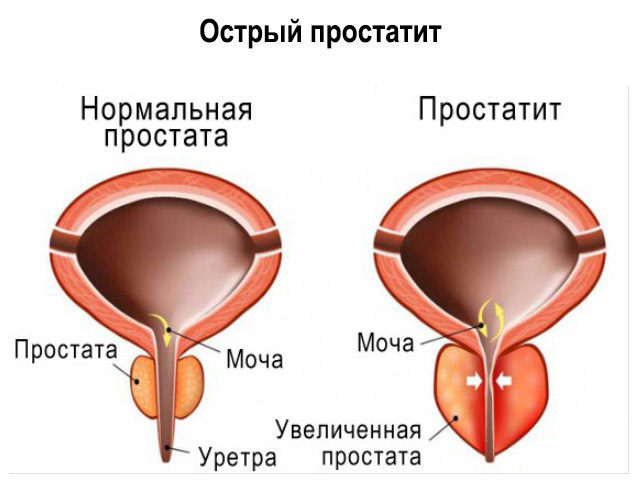 Индометацин (свечи и таблетки) при простатите: лечение и отзывы
