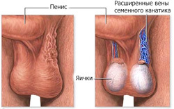 Влияет ли варикоцеле на потенцию мужчины и как?