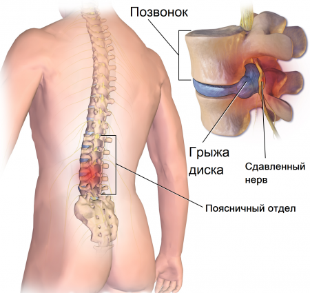 Как остеохондроз влияет на потенцию: что делать мужчине?