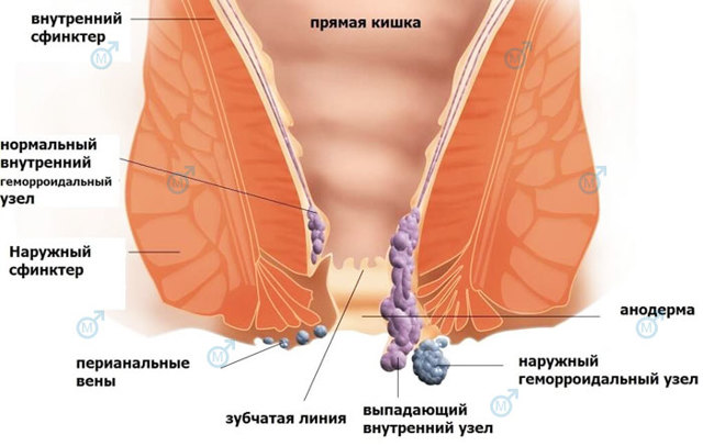 Влияет ли геморрой на потенцию у мужчин и как?