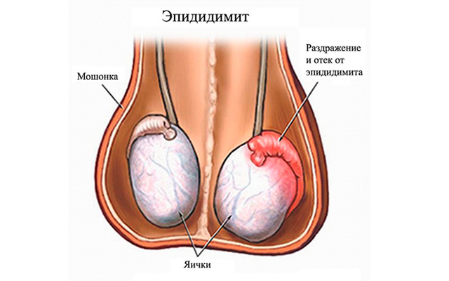 Опухли яички и болят у мужчины: причины, почему отекает мошонка, как лечить