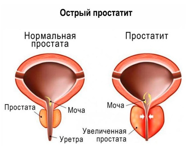 Острый простатит у мужчин: причины, симптомы и лечение