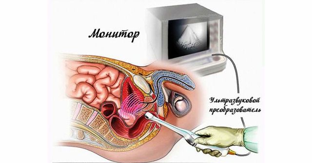 Простатит у ребенка и подростка: может ли быть, симптомы и лечение