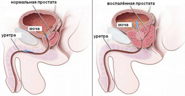 Гнойный простатит у мужчин: причины, признаки и симптомы, лечение, профилактика