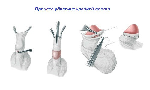 Где находится уздечка у мужчин (фото) на головке, что делать, если короткая и при других проблемах