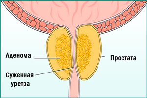Трихопол при простатите: инструкция по применению, лечение мужчин, отзывы