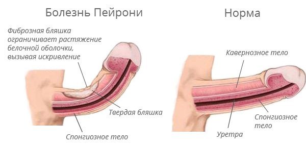 Кривой член (на фото): правда и мифы, почему секс с таким у мужчин нравится девушкам, что делать