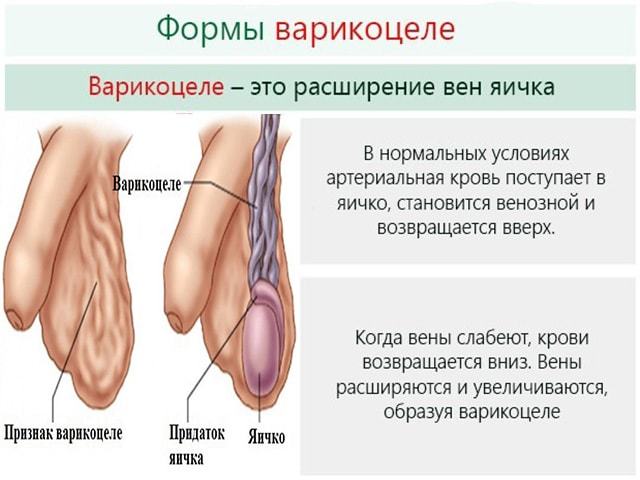 Влияет ли варикоцеле на потенцию мужчины и как?