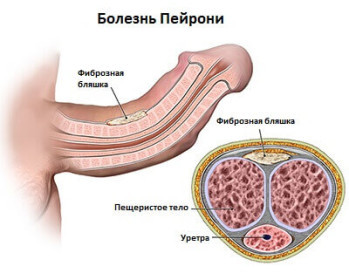 Болит член после секса: почему и что делать мужчине?
