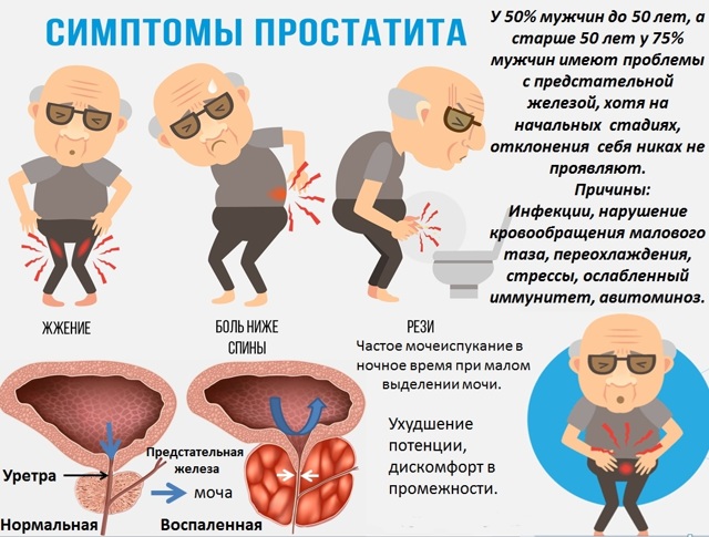 Мазь от простатита: рейтинг, как применять в лечении, отзывы