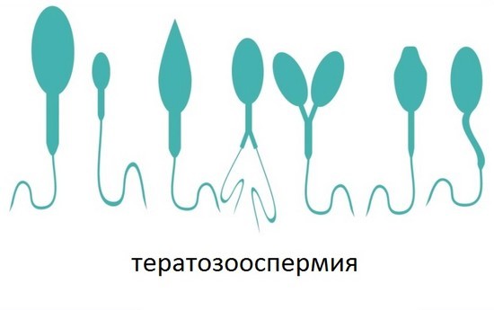 Тератозооспермия: лечение, что это значит у мужчин, беременность