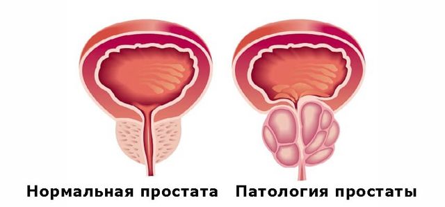 Простатит у ребенка и подростка: может ли быть, симптомы и лечение