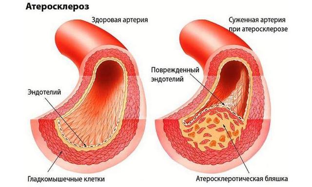 Сосудистая импотенция: лечение (препараты и способы), симптомы