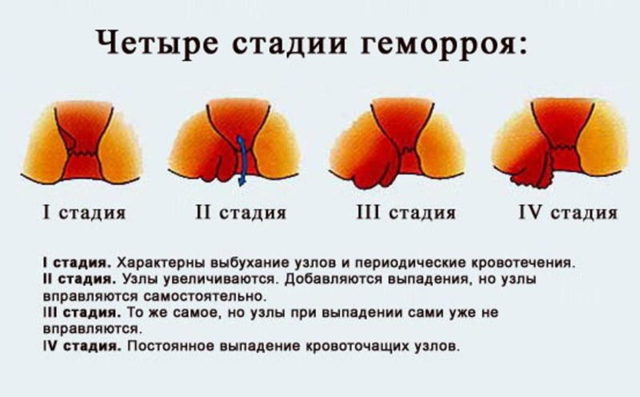 Нитроглицериновая мазь для повышения потенции у мужчин: инструкция по применению и отзывы