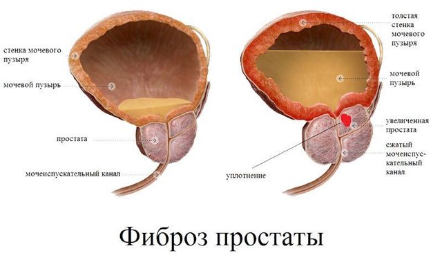 Калькулезный хронический простатит (камни в простате): симптомы и лечение, отзывы