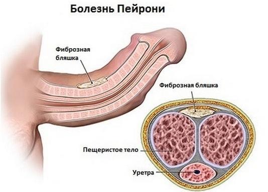 Полная импотенция (последняя стадия) у мужчин: признаки, что делать?