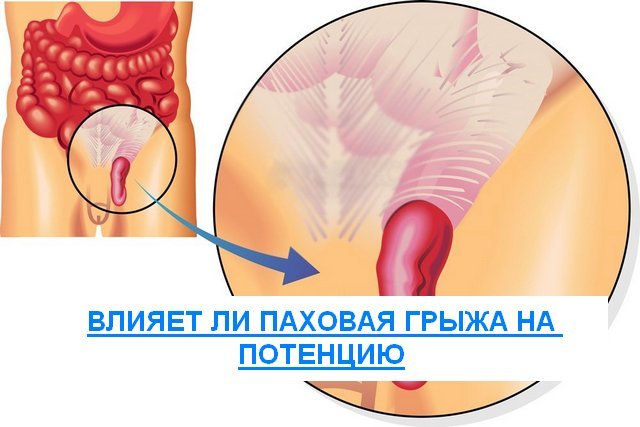 Влияние паховой грыжи на потенцию и эрекцию у мужчин