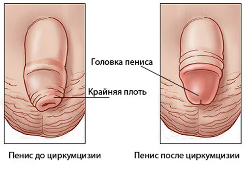 Где находится уздечка у мужчин (фото) на головке, что делать, если короткая и при других проблемах