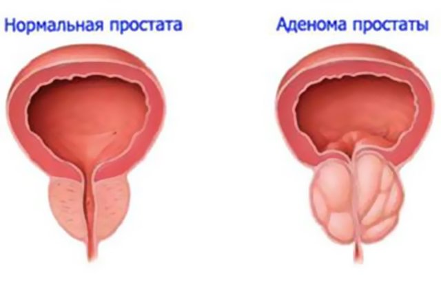 Частое мочеиспускание у мужчин без боли: причины, симптомы, лечение