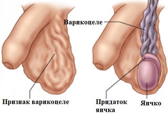 Влияет ли варикоцеле на потенцию мужчины и как?