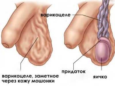 Одно яичко ниже другого у мужчин: почему и что делать?