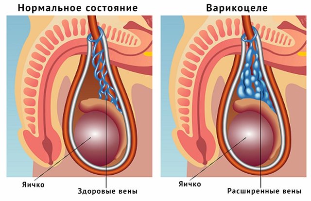 Влияет ли варикоцеле на потенцию мужчины и как?
